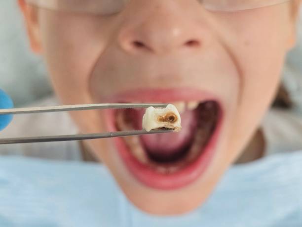 Best Emergency Root Canal Treatment in Walnut Grove, GA